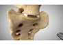 do 3d orthopedic spinal surgery animation joint replacement arthroscopy video