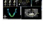 do implant planning ,surgical guide using blue sky and b4d