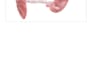 create best 3d medical explainer animation video for 3d sepsis retained placenta