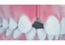 create realistic 3d dental impact and medical animation video