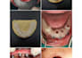 plan and design surgical guide