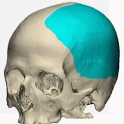 prosthesismf