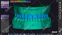 design   smile design, mockup, snap on smile  with exocad