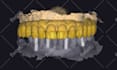 do dental prosthesis crown design using exocad, 3shape, inlab and cerec