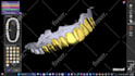 design custom tooth grills designs using exocad