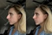 realistic nose job rhinoplasty photo simulation surgery