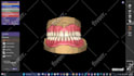 design high quality dentures using exocad