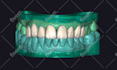 do digital smile design project for a perfect smile transformation