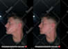 realistic nose job rhinoplasty photo simulation surgery