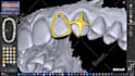design custom tooth grills designs using exocad
