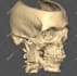 convert medical dicom images to stl and 3d printable models