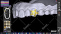 design custom tooth grills designs using exocad