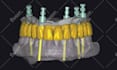 do dental prosthesis crown design using exocad, 3shape, inlab and cerec