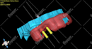 do implant planning, surgical guides, and stackable guides