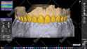 design   smile design, mockup, snap on smile  with exocad