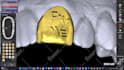 design custom tooth grills designs using exocad