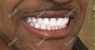 whiten, clean, and fix yellow teeth for stunning photos