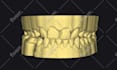 do dental prosthesis crown design using exocad, 3shape, inlab and cerec