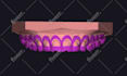 design prep guide or gingivectomy guide for your dental practice