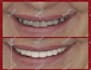 design   smile design, mockup, snap on smile  with exocad