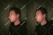 realistic nose job rhinoplasty photo simulation surgery