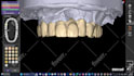 design   smile design, mockup, snap on smile  with exocad