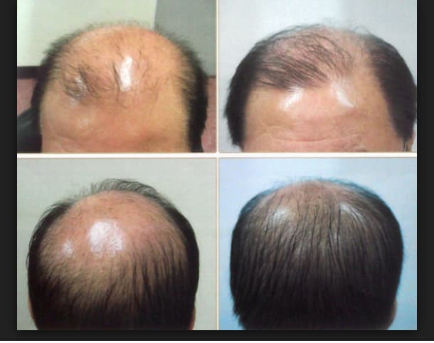 Teach How To Stop Hair Loss And Regrow Hair Asap By Opulence23