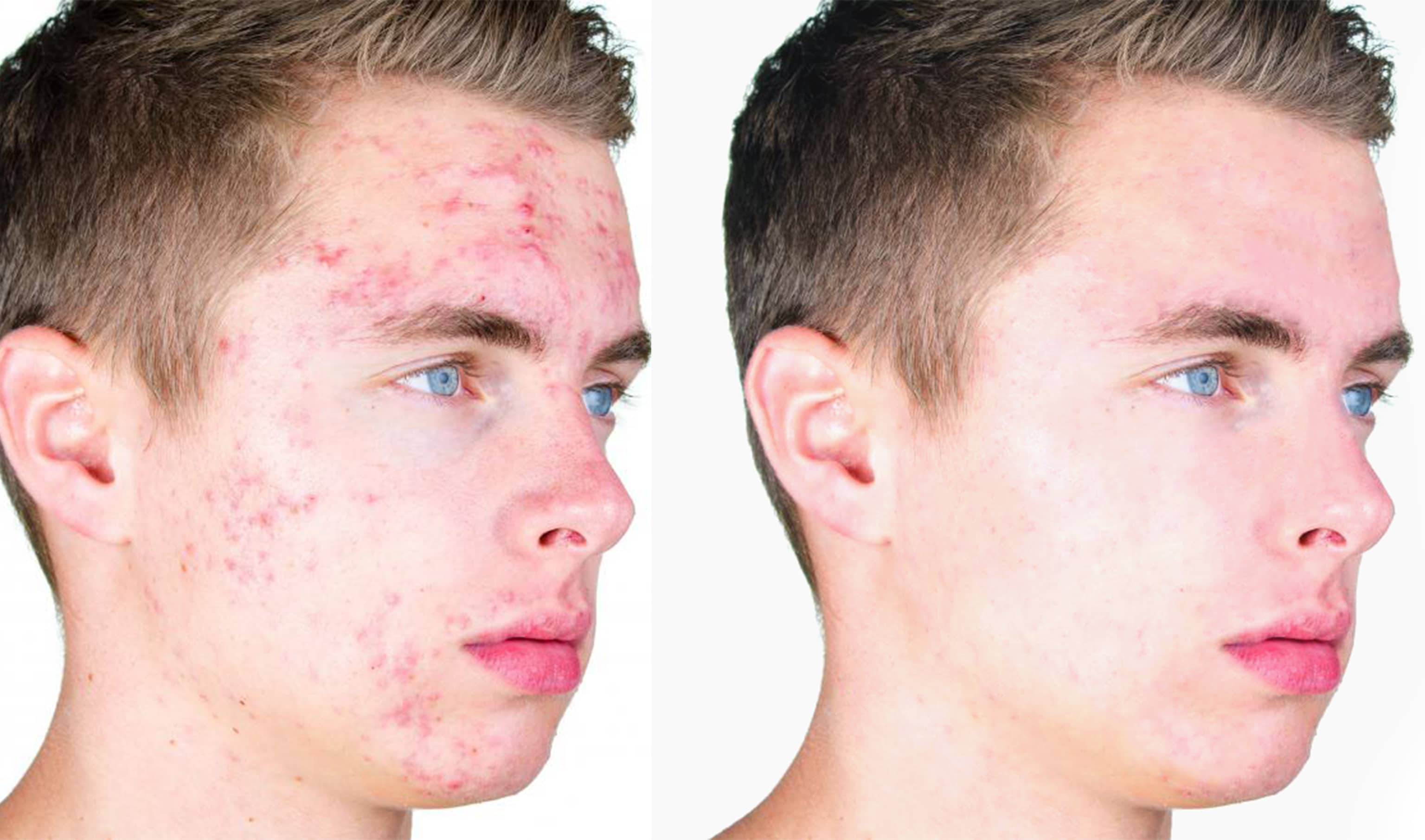 what are acne dark spots