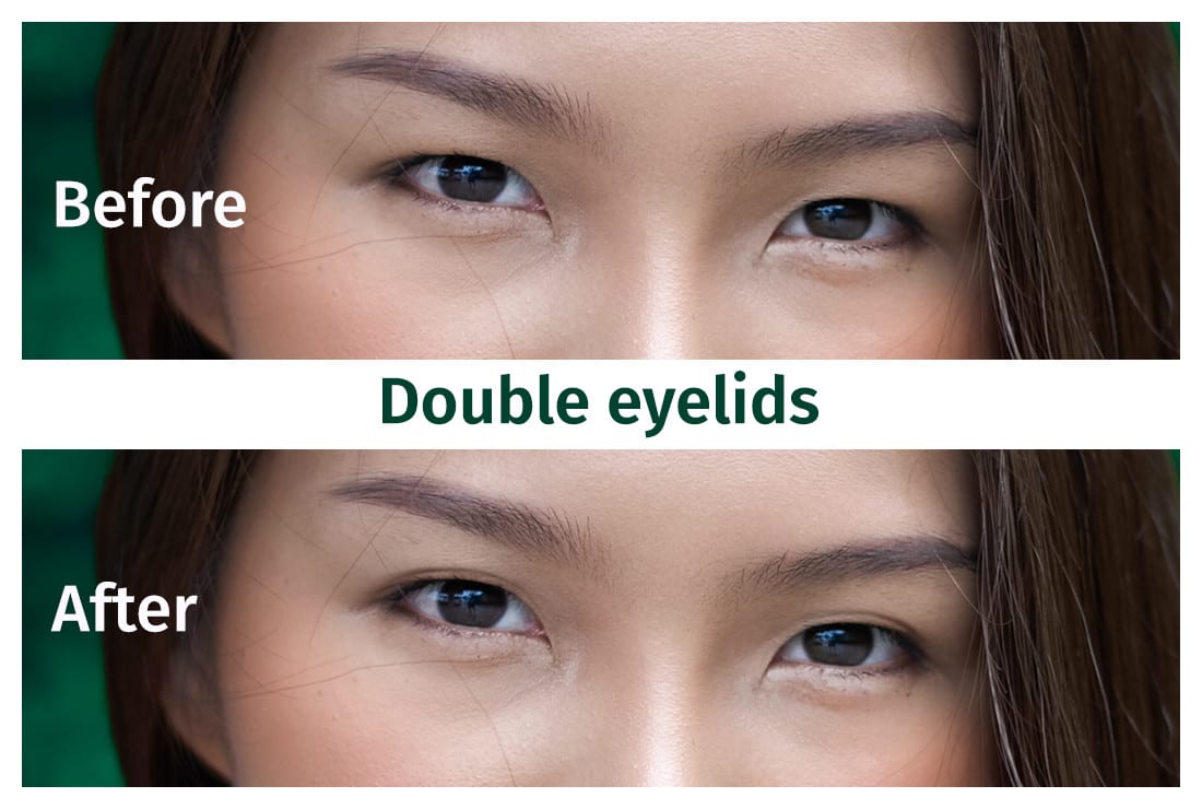 how to get double eyelids naturally