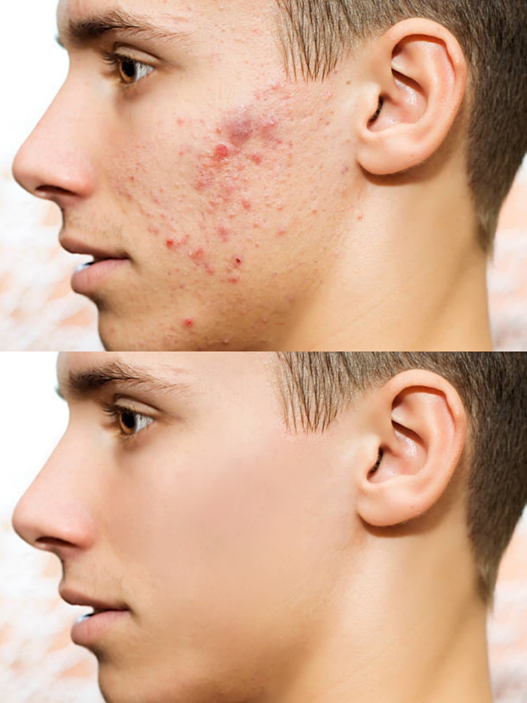acne removal