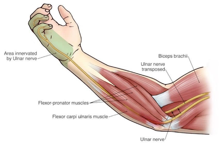 Flexor Pronator Muscle Help You To Cure Ulnar Nerve Problem