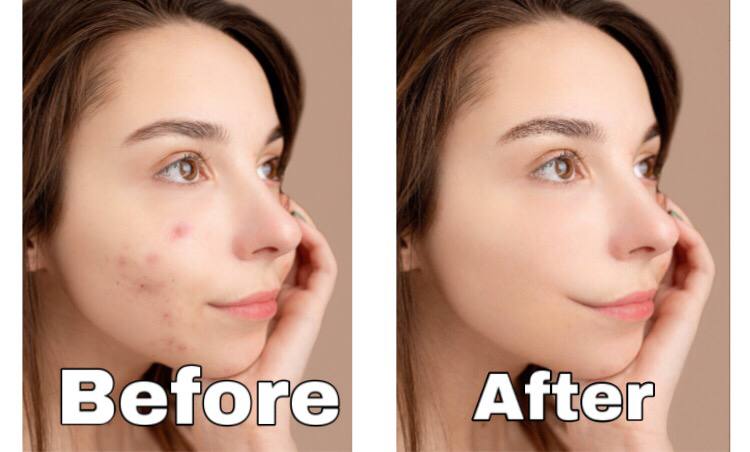 retouch your image remove pimples wrinkles acne and blemishes