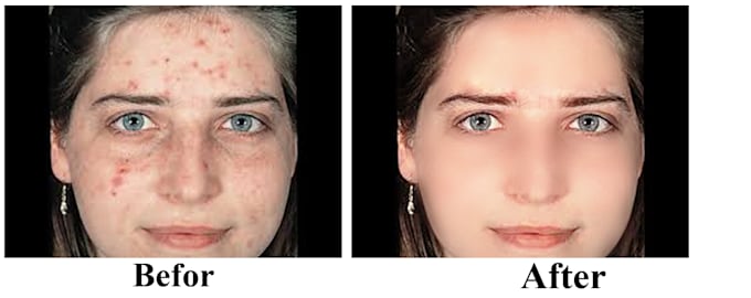 remove dark spots on face, damage, pox scars etc