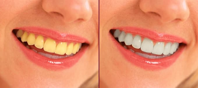 clean and fix yellow teeth with photoshop
