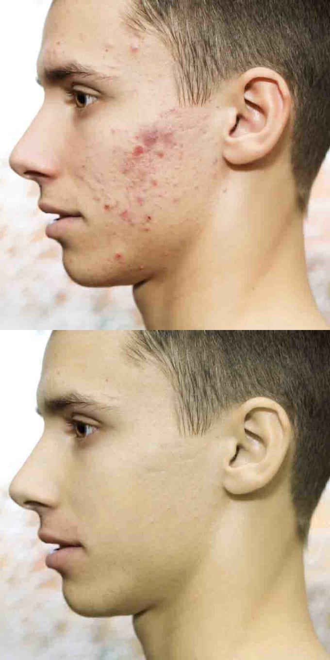 Remove Acnes Freckles Scars Or Any Skin Change By Weblabdesignx