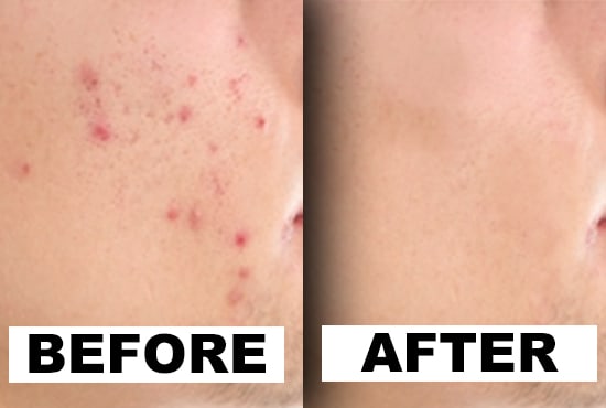 Remove your acne and scars by Jacksoncreates | Fiverr
