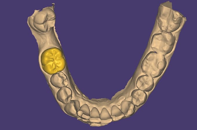 design dental crowns and bridges using exocad