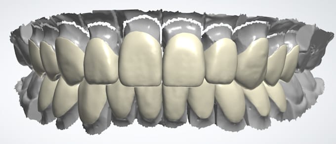 Do waxup mockup and monolithic zirconia design using 3shape by ...
