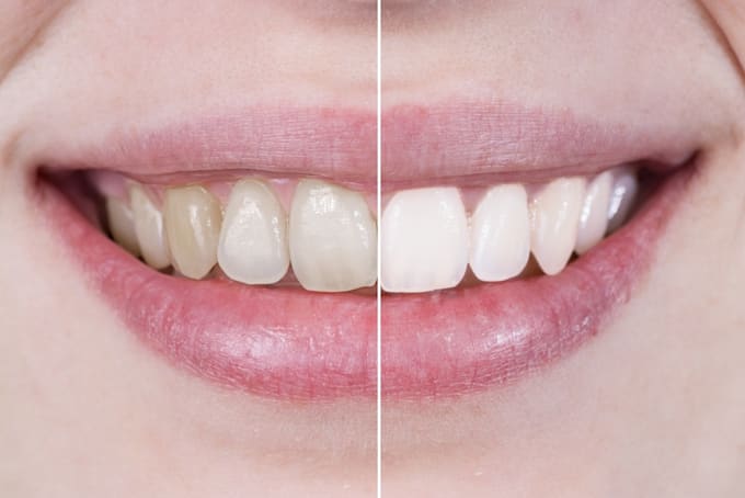 tell you how to get white teeth safely