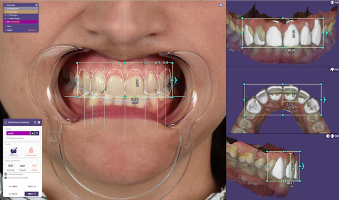 do digital smile design project for a perfect smile transformation