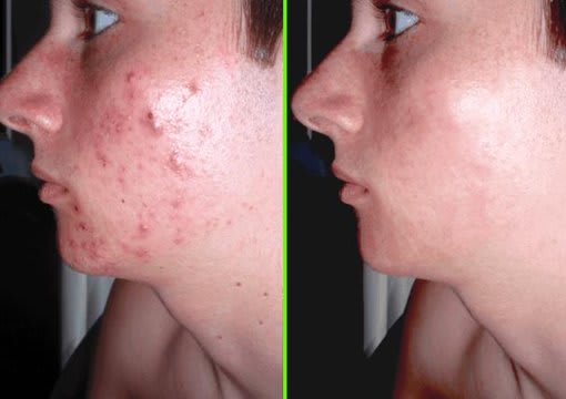 remove pimple and scars from your picture using Photoshop