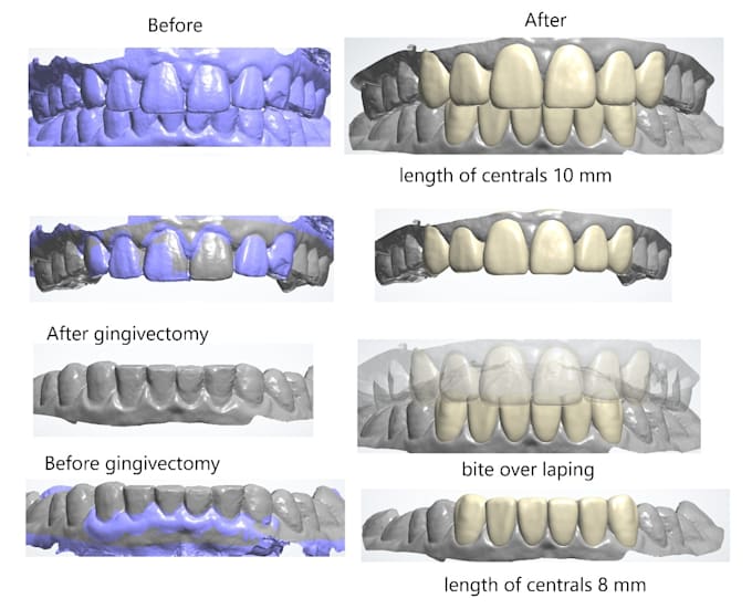 do veneers and glass ceramics veneers design using 3shape