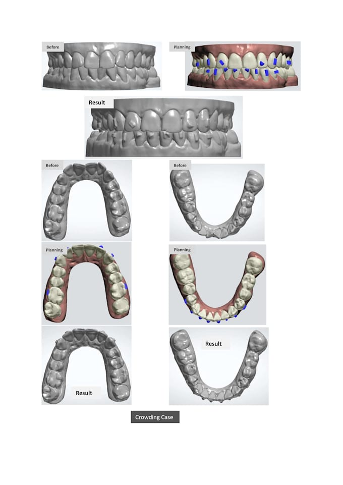 do aligners treatment planning using 3shape orthosystem