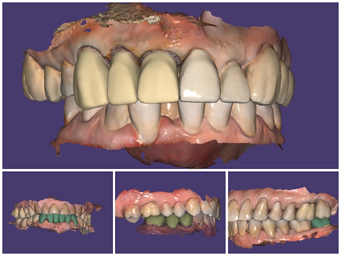 Design dental prosthesis in exocad by Bilalshafiqu401 | Fiverr