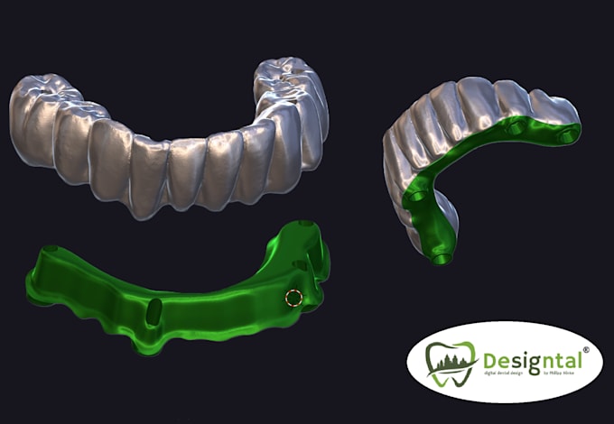 do master crafted dental design for hybridbridge with b4d ibar