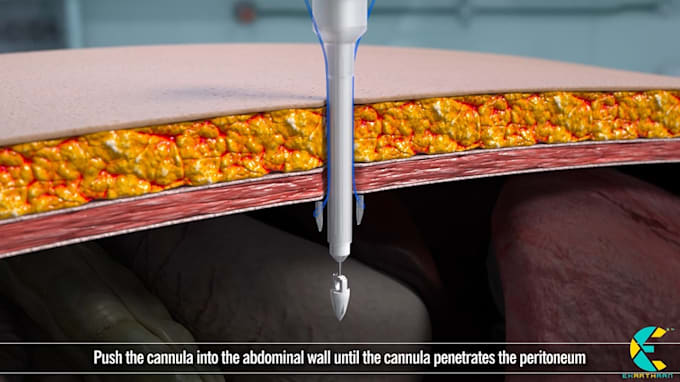 make a realistic 3d medical device surgery cgi animation