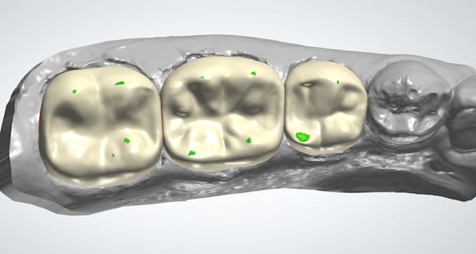 Design high quality crown and bridges on 3shape and exocad by ...