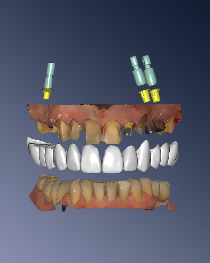 design bridges and crowns on implants