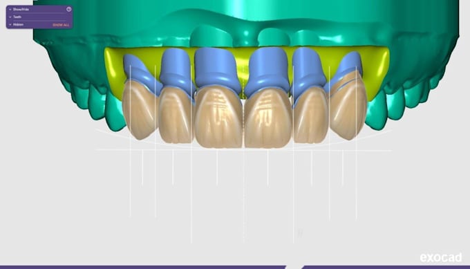design new smiles in exocad
