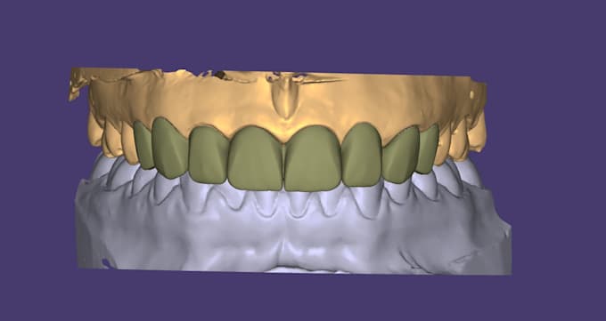 design dental crowns, bridges, implant crowns and partial dentures in exocad